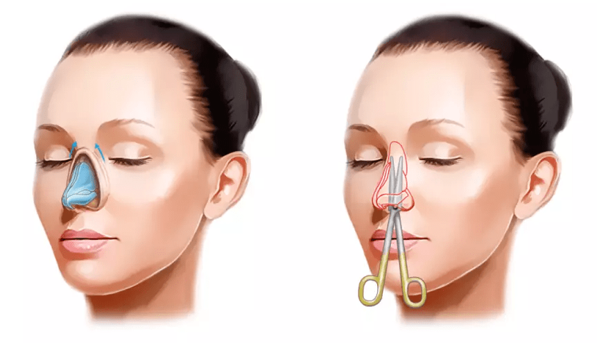 Rhinoplasty operation