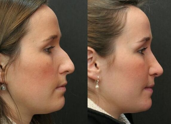 -Surgik before and after rhinoplast