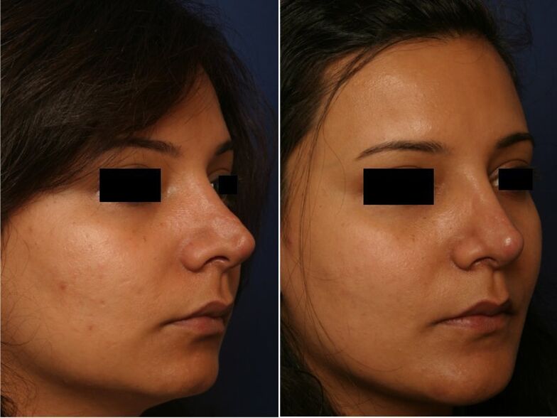 The result of plastic surgery