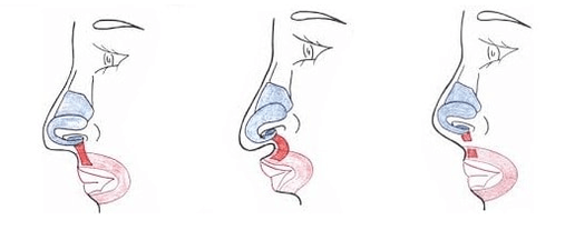 Excision of part of the nasal muscle