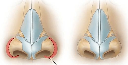 Reduction of nostrils