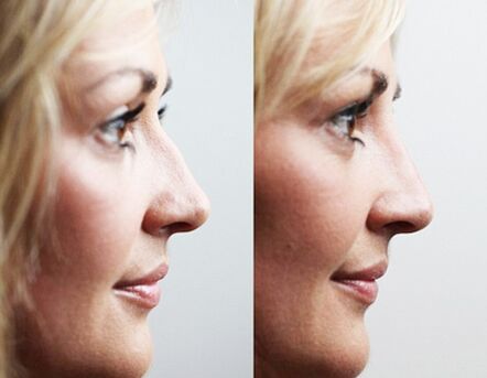 Before and after rhinoplasty with filling