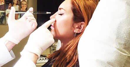 Rhinoplasty surgery with filling