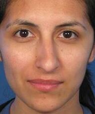 Irregular nose shape is the reason for plastic surgery