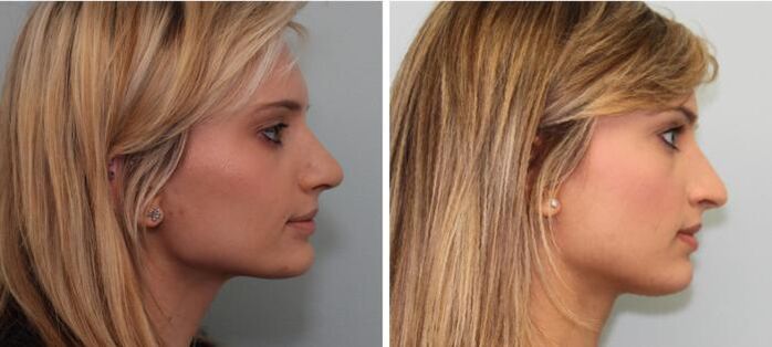 Results before and after rhinoplasty