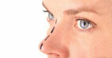 Marking on the nose for the insertion of cosmetic threads