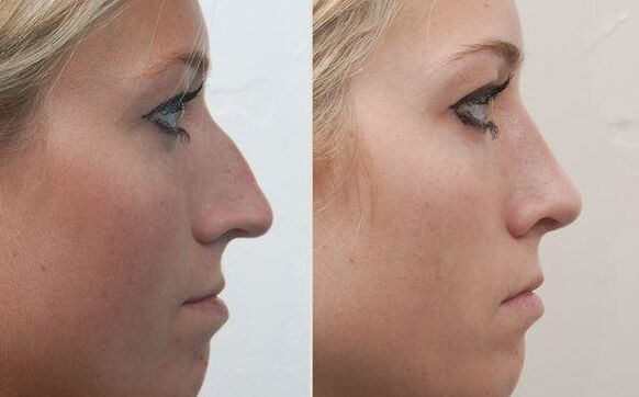 is the result of nasal rhinoplasty