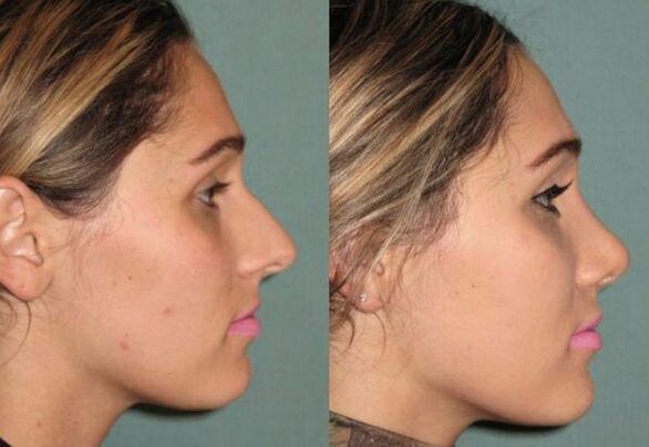 is the result of non-injection rhinoplasty
