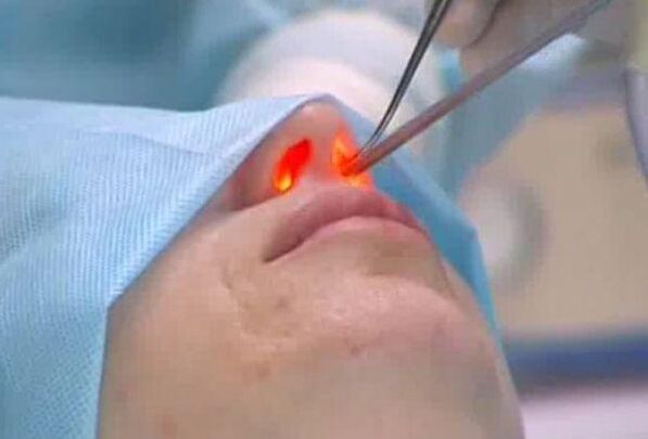 nasal laser rhinoplasty