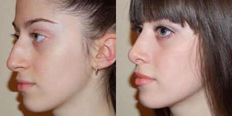 photographs before and after nasal rhinoplasty