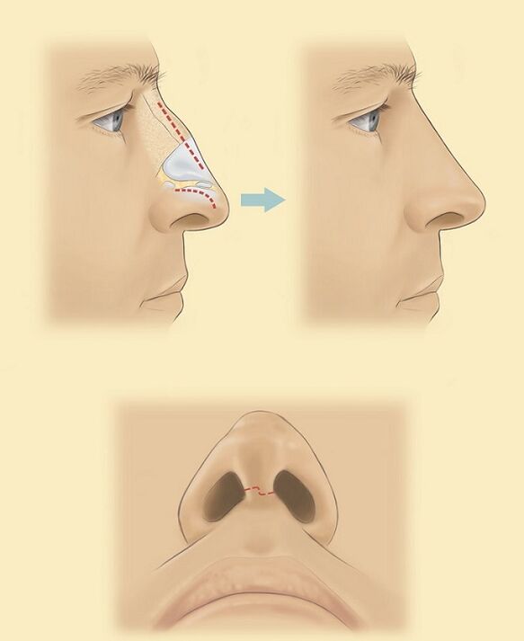scheme for nasal surgery