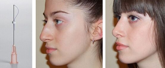 before and after rhinoplasty with nasal teeth