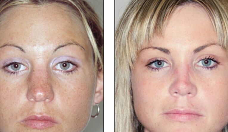 Before and after unsuccessful nasal rhinoplasty