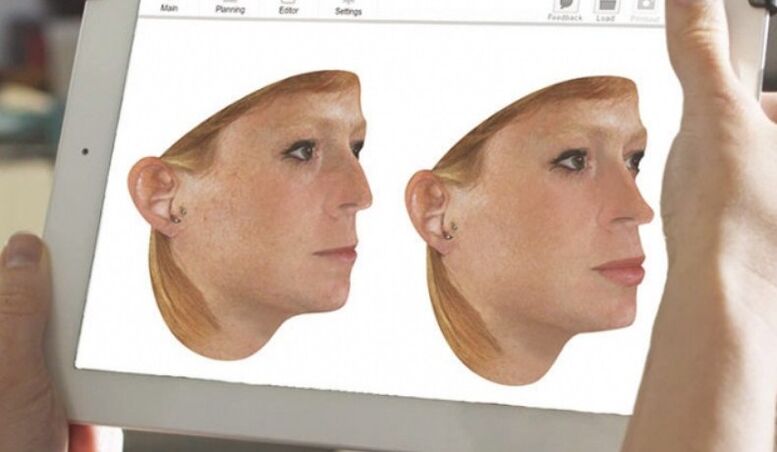 Computer modeling of the nose before rhinoplasty