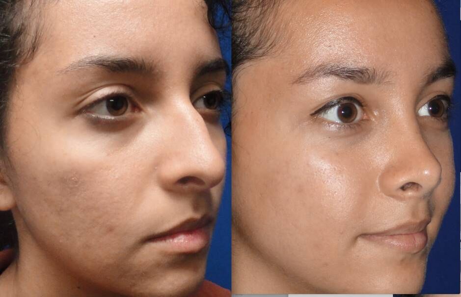 photographs before and after closed rhinoplasty