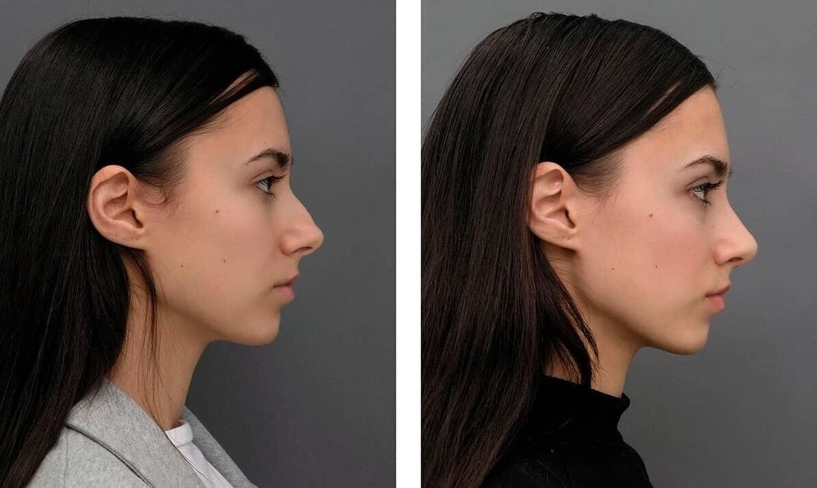 photographs before and after rhinoplasty