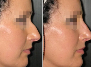 Non-surgical rhinoplasty