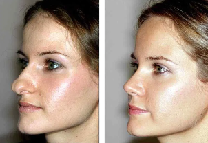 Rhinoplasty nose