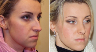 Rhinoplasty