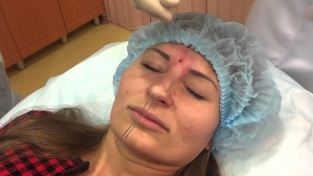 Sutures are inserted under the skin of the nose