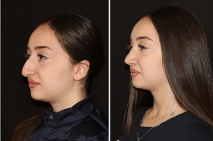 The result of straightening of the nose after rhinoplasty